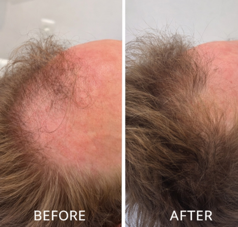 Hair transformation with Hair Filler — 4 sessions at 2-week intervals.